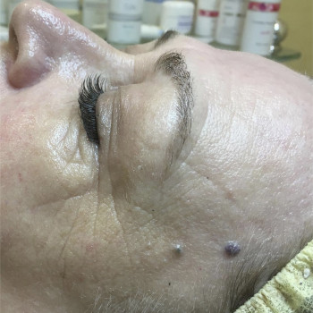 Программа Silk для моментального лифтинг эффекта
                    Косметолог Инна Мариуполь