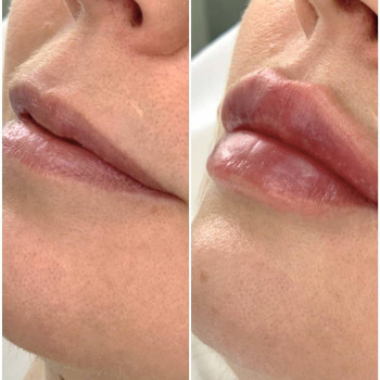 Ботокс губ
                    Косметолог Мария Київ