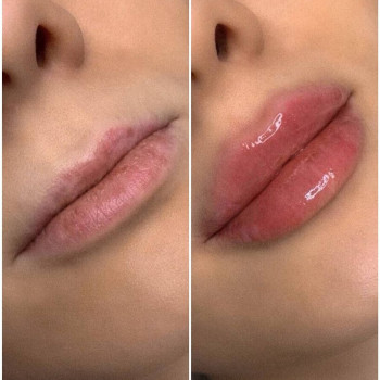 Ботокс губ
                    Косметолог Мария Київ