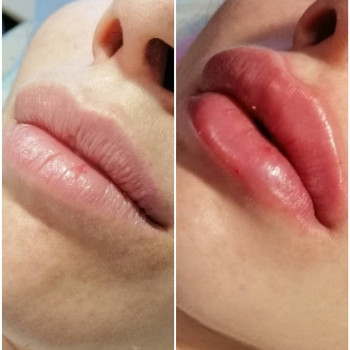 Ботокс губ
                    Косметолог Мария Київ