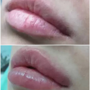 Ботокс губ
                    Косметолог Мария Київ