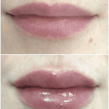 Ботокс губ
                    Косметолог Мария Київ