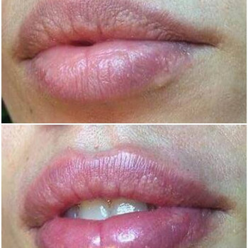 Ботокс губ
                    Косметолог Мария Київ