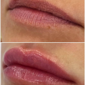 Ботокс губ
                    Косметолог Мария Київ