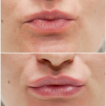 Ботокс губ
                    Косметолог Мария Київ