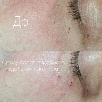 Видалення папілом