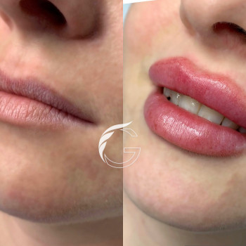 Збільшення губ