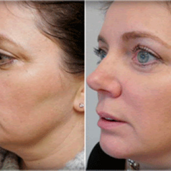 Мезотерапия
                    Косметолог Инна Мариуполь