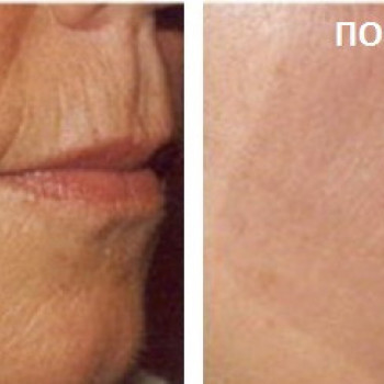 Мезотерапия
                    Косметолог Инна Мариуполь