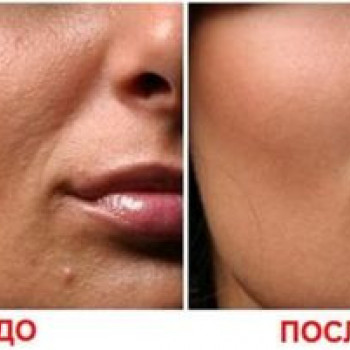 Мезотерапия
                    Косметолог Инна Мариуполь