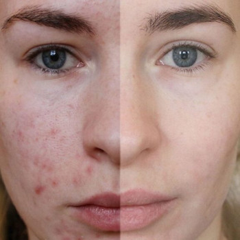 Мезотерапия
                    Косметолог Инна Мариуполь