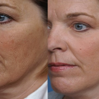 Мезотерапия
                    Косметолог Инна Мариуполь