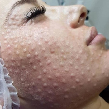 Биоревитализация
                    Косметолог Инна Мариуполь