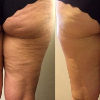 4 процедуры