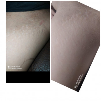 Ростяжки 
Результат после первой процедуры. Нарастает до 3 м