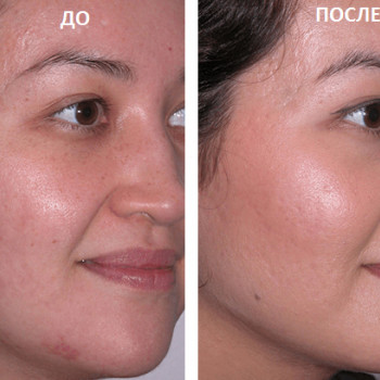 Гликолиевый пилинг
                    Косметолог Инна Мариуполь