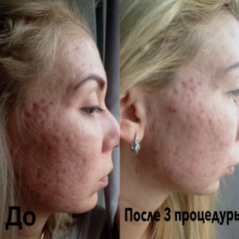 Гликолиевый пилинг
                    Косметолог Инна Мариуполь