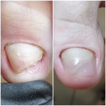 Протезирование