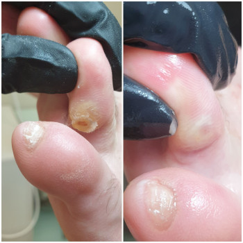 Удалнние межпальцевой мозоли