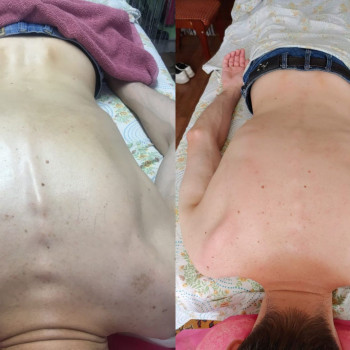 Лечение сколиоза,устранение кифоза грудного отдела