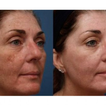 Миндальный пилинг
                    Косметолог Инна Мариуполь