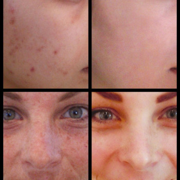 ТСА-пилинг
                    Косметолог Инна Маріуполь