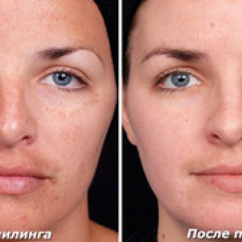 ТСА-пилинг
                    Косметолог Инна Маріуполь