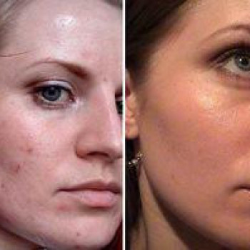 ТСА-пилинг
                    Косметолог Инна Маріуполь