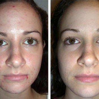 ТСА-пилинг
                    Косметолог Инна Маріуполь