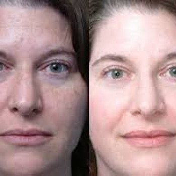 ТСА-пилинг
                    Косметолог Инна Маріуполь