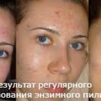 Энзимный или ферментативный пилинг
                    Косметолог Инна Мариуполь