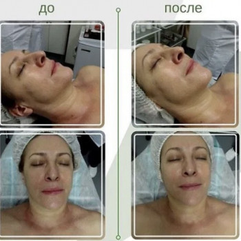 Энзимный или ферментативный пилинг
                    Косметолог Инна Мариуполь