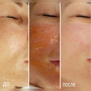 Энзимный или ферментативный пилинг
                    Косметолог Инна Мариуполь