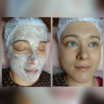 Энзимный или ферментативный пилинг
                    Косметолог Инна Мариуполь