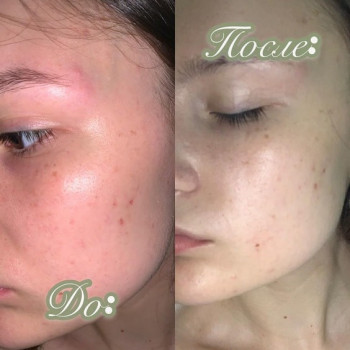 Энзимный или ферментативный пилинг
                    Косметолог Инна Мариуполь