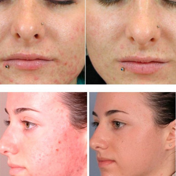 Азелаиновый пилинг
                    Косметолог Инна Мариуполь