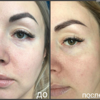 Азелаиновый пилинг
                    Косметолог Инна Мариуполь