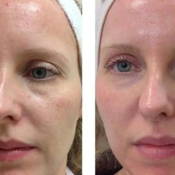 Азелаиновый пилинг
                    Косметолог Инна Мариуполь