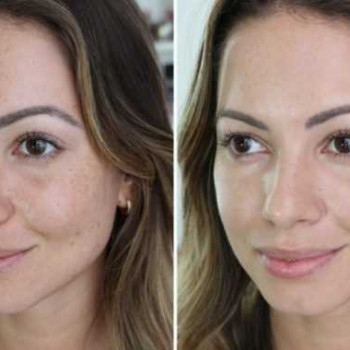 Азелаиновый пилинг
                    Косметолог Инна Мариуполь