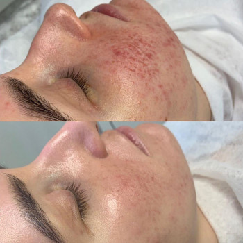 Азелаиновый пилинг
                    Косметолог Инна Мариуполь