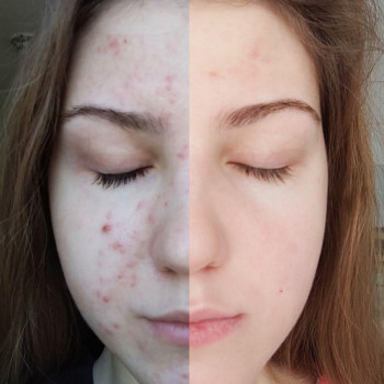 Азелаиновый пилинг
                    Косметолог Инна Мариуполь