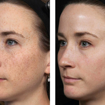 Феруловый пилинг
                    Косметолог Инна Мариуполь