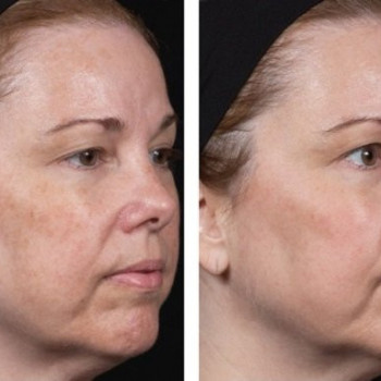 Феруловый пилинг
                    Косметолог Инна Мариуполь