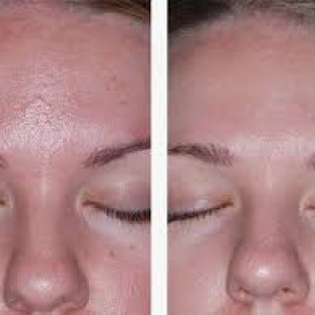 Феруловый пилинг
                    Косметолог Инна Мариуполь