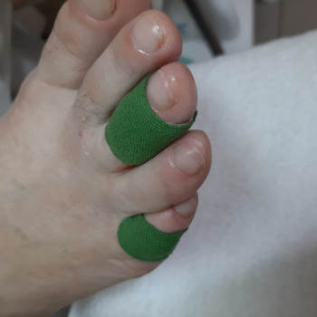 Работа с межпальцевыми мозолями