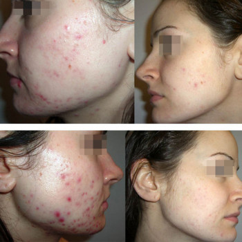 АБР-пилинг (или ABR-пилинг)
                    Косметолог Инна Мариуполь