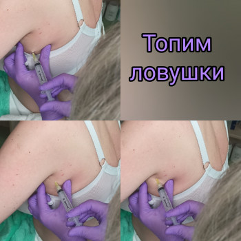 Использование липолитических коктейлей