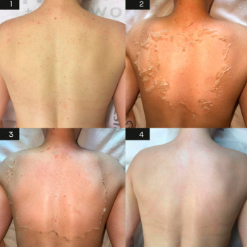 КОРАЛЛОВЫЙ ПИЛИНГ ROSE DE MЕR
                    Косметолог Инна Мариуполь