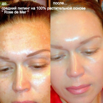 КОРАЛЛОВЫЙ ПИЛИНГ ROSE DE MЕR
                    Косметолог Инна Мариуполь