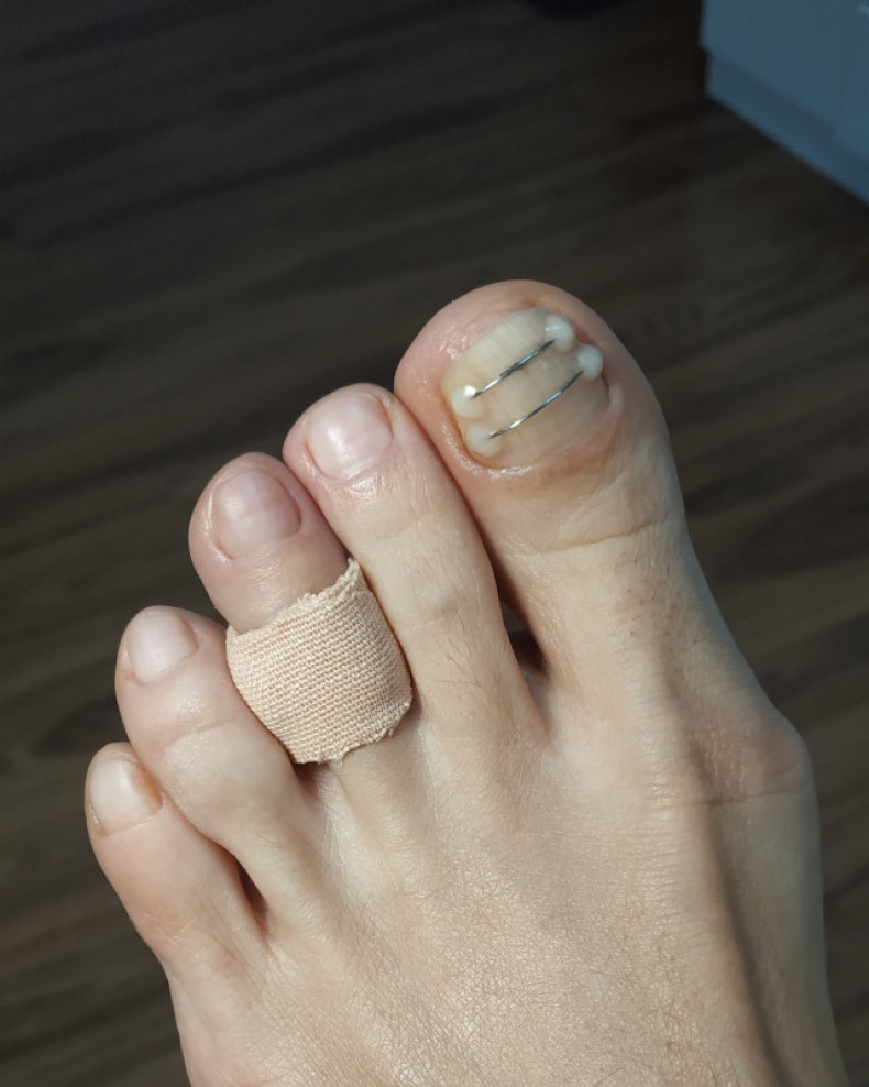 Разгрузочная съёмная повязка на палец от мозоля 150 грн, фото - Подолог Веста Меладзе